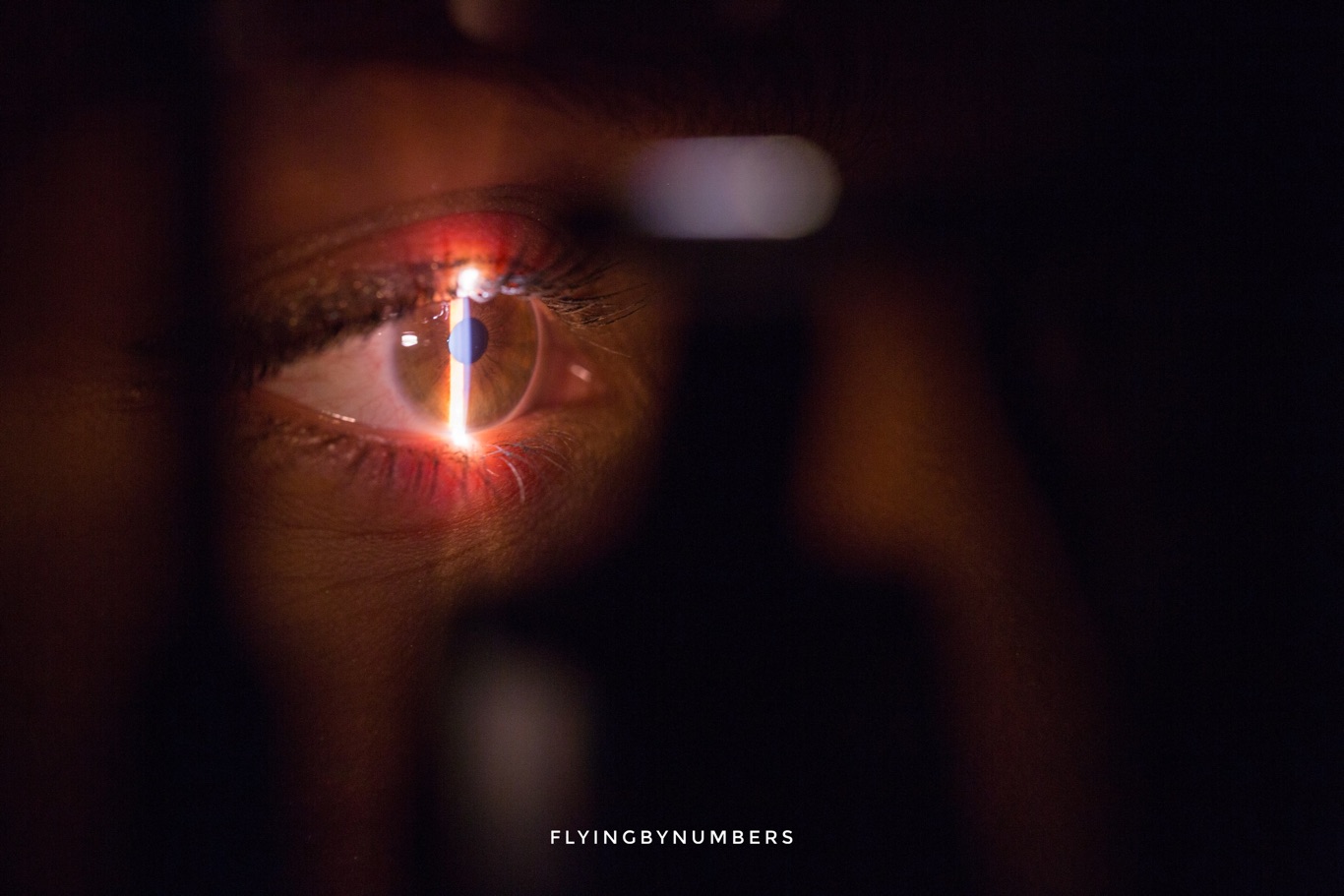 Can Pilots have laser eye surgery?